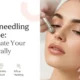 Microneedling Near Me